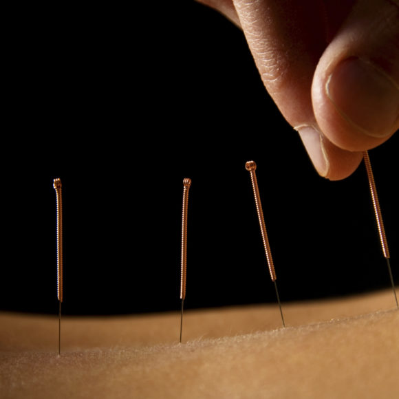 Onlinekurs Akupunktur – Wie geht das denn?
