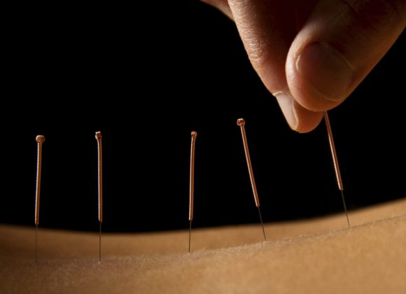 Akupunktur Starterkurs