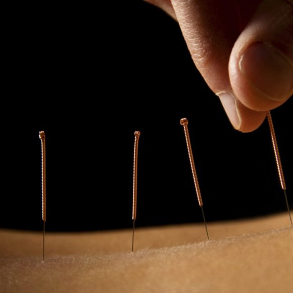 Stress mit Akupunktur behandeln