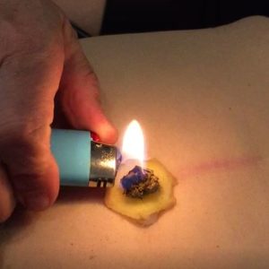Moxibustion – Eine Zusatztherapie in der Akupunktur